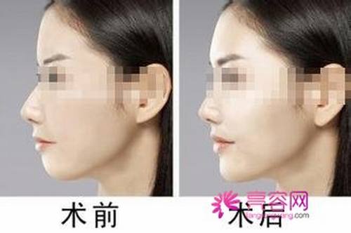 想做假体的妹子看过来!膨体垫下巴取出假体可以吗?
