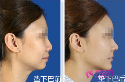 想做假体的妹子看过来!膨体垫下巴取出假体可以吗?
