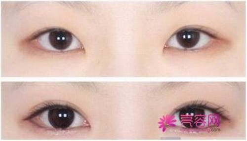 妹子们看过来!双眼皮知识科普:开眼角会留疤痕吗,开眼角多少钱?