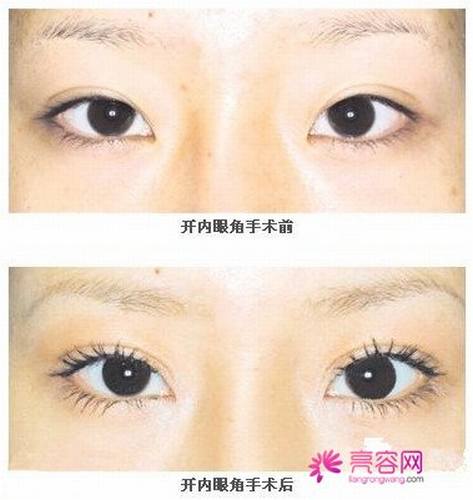 妹子们看过来!双眼皮知识科普:开眼角会留疤痕吗,开眼角多少钱?