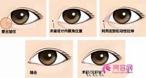 妹子们看过来!双眼皮知识科普:开眼角会留疤痕吗,开眼角多少钱?
