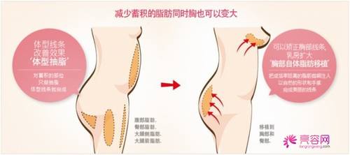 涨姿势!科普隆胸知识!自体脂肪移植隆胸的果怎么样?价格多少钱?