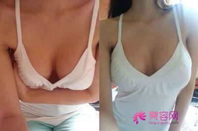 给妹子们科普一下假体隆胸!假体隆胸果怎么样?如何假体隆胸没问题性?