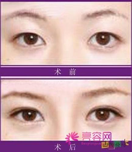 哪个整形医院割双眼皮较好