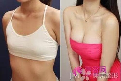 副乳切除果怎么样怎么样价格案例