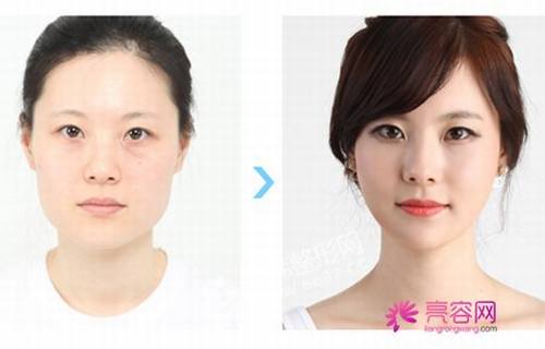 做卧蚕后的护理怎么样价格案例