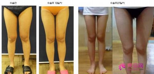 大腿吸脂没问题因素有哪些