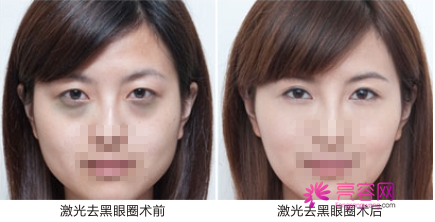你想去黑眼圈吗?为你详解激光去黑眼圈几次能见