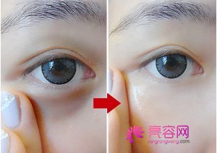 你想去黑眼圈吗?为你详解激光去黑眼圈几次能见