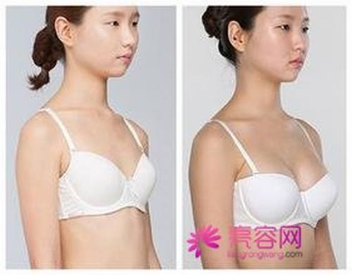 来聊聊女性都十分关注的话题:隆胸后是否可以哺乳!?