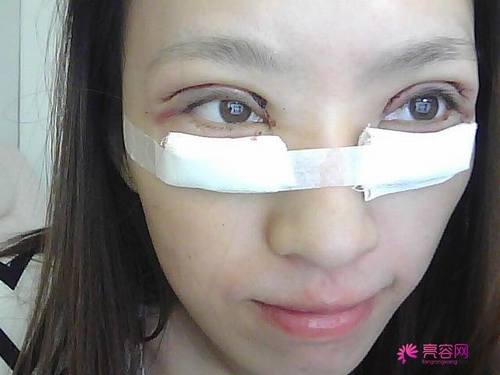 你真的了解双眼皮吗?爱美女性看过来!为你详解:割双眼皮常用方法有哪些?恢复要多久?