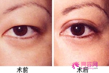 你真的了解双眼皮吗?爱美女性看过来!为你详解:割双眼皮常用方法有哪些?恢复要多久?