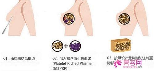 姐妹们快看过来!为你详细介绍:自体脂肪移植隆胸需要做几次?其优点有哪些?术后会反弹吗?