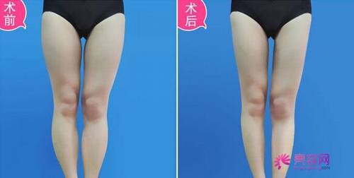亲们看过来!!来了解一下大腿吸脂术后护理?大腿吸脂没问题性影响因素?