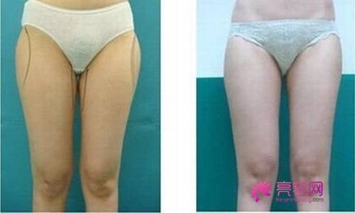 亲们看过来!!来了解一下大腿吸脂术后护理?大腿吸脂没问题性影响因素?