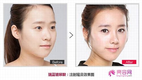 玻尿酸隆鼻需要多少量?恢复期多长时间?术后该如何护理?