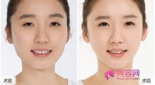 玻尿酸隆鼻需要多少量?恢复期多长时间?术后该如何护理?