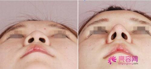 姐妹们看过来!你想做假体隆鼻吗?假体隆鼻手术的果自然吗?能你的预期果吗?
