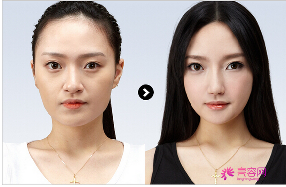 姐妹们看过来!你想做假体隆鼻吗?假体隆鼻手术的果自然吗?能你的预期果吗?
