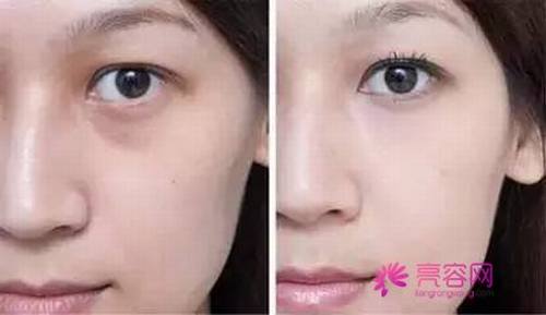 亲爱的注意啦!看看自己的脸,看看自己有眼袋吗?本文为你解析祛眼袋的常用方法?祛眼袋手术后果可以维持多久呢?