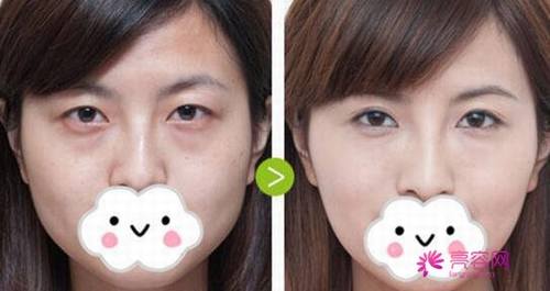 亲爱的注意啦!看看自己的脸,看看自己有眼袋吗?本文为你解析祛眼袋的常用方法?祛眼袋手术后果可以维持多久呢?