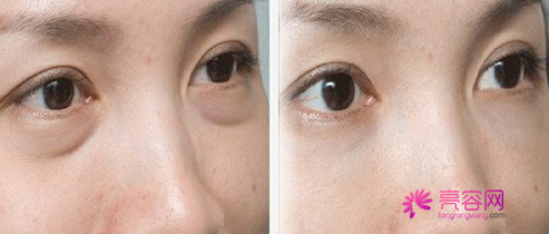 亲爱的注意啦!看看自己的脸,看看自己有眼袋吗?本文为你解析祛眼袋的常用方法?祛眼袋手术后果可以维持多久呢?