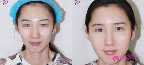 干货来袭!来来来!各位爱美少女们快快点进来看看!关于自体脂肪丰面颊的相关知识介绍!让我们一起来了解一下自体脂肪丰面颊后表情会变僵硬吗?