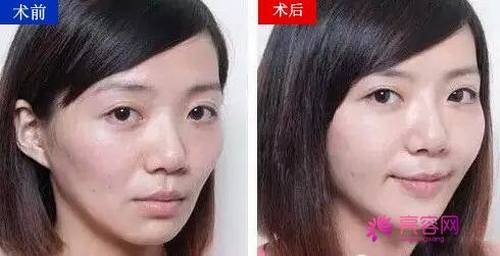 干货来袭!来来来!各位爱美少女们快快点进来看看!关于自体脂肪丰面颊的相关知识介绍!让我们一起来了解一下自体脂肪丰面颊后表情会变僵硬吗?