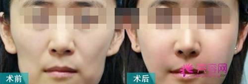 干货来袭!来来来!各位爱美少女们快快点进来看看!关于自体脂肪丰面颊的相关知识介绍!让我们一起来了解一下自体脂肪丰面颊后表情会变僵硬吗?