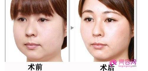 打注射瘦脸需要打几个疗程吗?注射注射瘦脸打一针就行了吗?脸大妹子的福音------注射瘦脸!