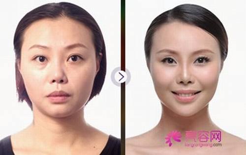 打注射瘦脸需要打几个疗程吗?注射注射瘦脸打一针就行了吗?脸大妹子的福音------注射瘦脸!