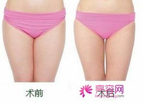 大象腿的福音!瘦!瘦!瘦!看看你的大腿够瘦吗?大腿吸脂!你怎么看?今天给各位讲解讲解腿部吸脂!