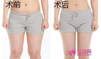 大象腿的福音!瘦!瘦!瘦!看看你的大腿够瘦吗?大腿吸脂!你怎么看?今天给各位讲解讲解腿部吸脂!