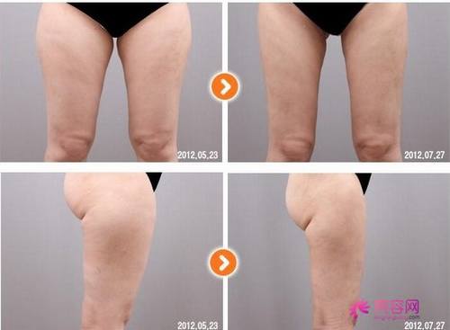大象腿的福音!瘦!瘦!瘦!看看你的大腿够瘦吗?大腿吸脂!你怎么看?今天给各位讲解讲解腿部吸脂!