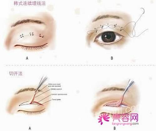 单眼皮妹纸们!你了解埋线双眼皮手术的线会断吗?!看过来吧!今天我们就谈谈埋线的相关问题!