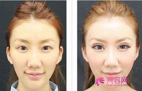单眼皮妹纸们!你了解埋线双眼皮手术的线会断吗?!看过来吧!今天我们就谈谈埋线的相关问题!