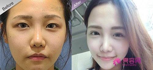 单眼皮妹纸们!你了解埋线双眼皮手术的线会断吗?!看过来吧!今天我们就谈谈埋线的相关问题!
