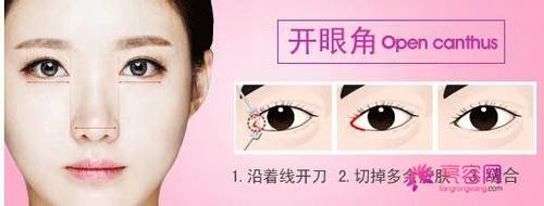 开眼角知识解答:开眼角术后多久可以正常上班?开眼角有哪些优势?及失败修复?