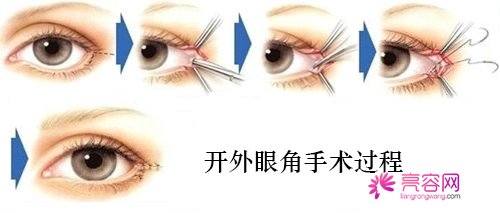 开眼角知识解答:开眼角术后多久可以正常上班?开眼角有哪些优势?及失败修复?