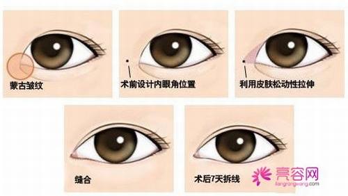 开眼角知识解答:开眼角术后多久可以正常上班?开眼角有哪些优势?及失败修复?