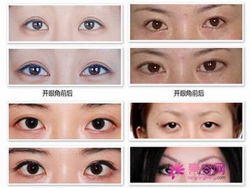 开眼角知识解答:开眼角术后多久可以正常上班?开眼角有哪些优势?及失败修复?