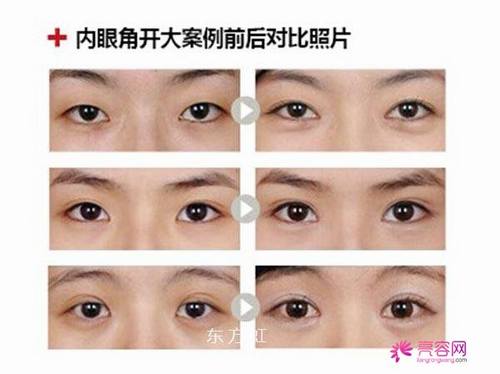 开眼角知识解答:开眼角术后多久可以正常上班?开眼角有哪些优势?及失败修复?