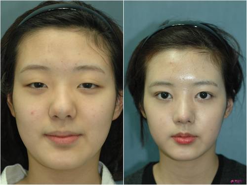 开眼角知识解答:开眼角术后多久可以正常上班?开眼角有哪些优势?及失败修复?