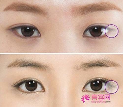 开眼角知识解答:开眼角术后多久可以正常上班?开眼角有哪些优势?及失败修复?