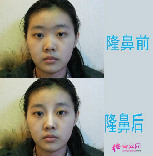 长文!多图!慎入!盘点假体隆鼻要点!假体隆鼻优势及其没问题性综合分析!