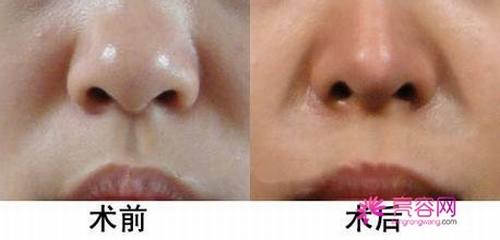长文!多图!慎入!盘点假体隆鼻要点!假体隆鼻优势及其没问题性综合分析!