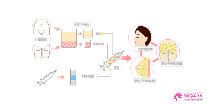 你知道自体脂肪隆胸吗?自体脂肪隆胸要点总结(一)