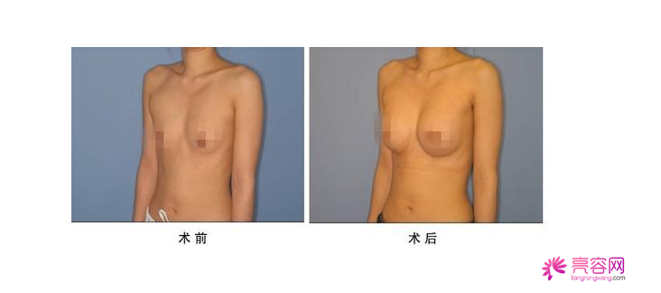 你知道自体脂肪隆胸吗?自体脂肪隆胸要点总结(一)