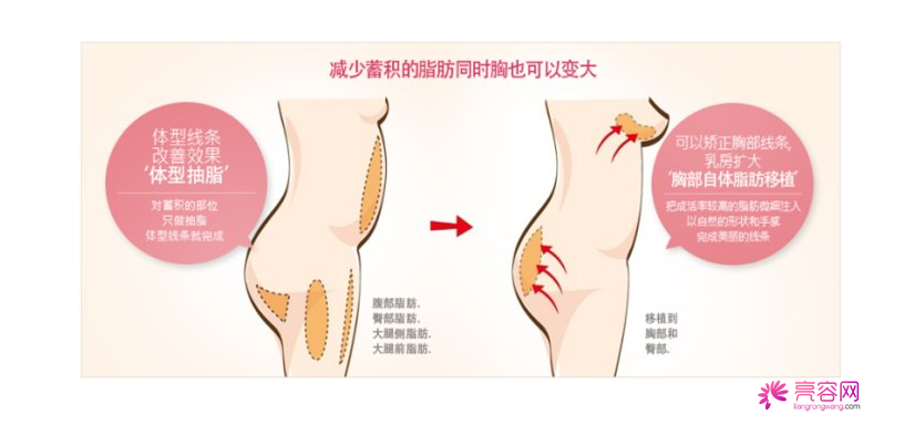你知道自体脂肪隆胸吗?自体脂肪隆胸要点总结(一)