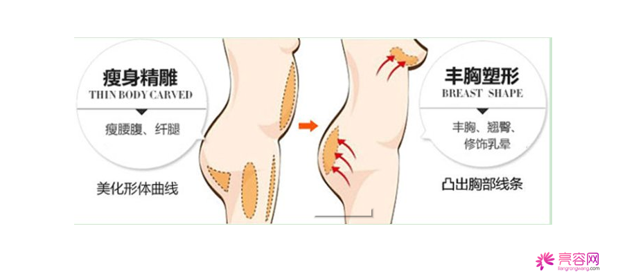 你知道自体脂肪隆胸吗?自体脂肪隆胸要点总结(二)